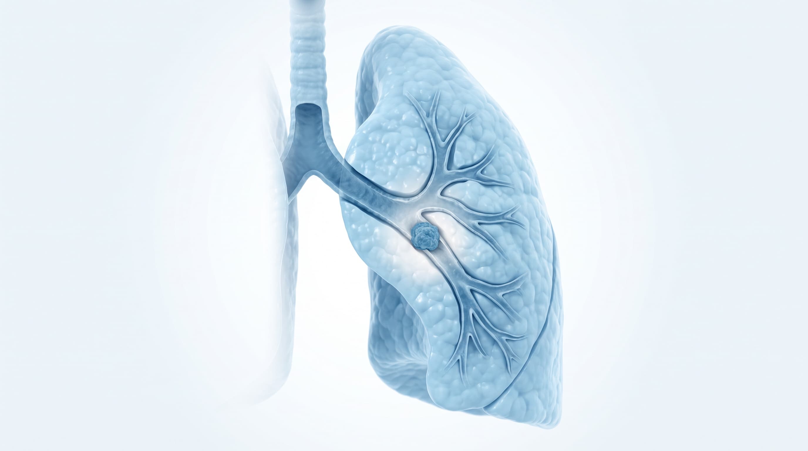 Cáncer de Pulmón